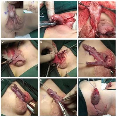 Application of a free preputial tube graft coupled with urethral plate urethroplasty combined with a Buck's fascia integral covering for the single-stage repair of severe hypospadias